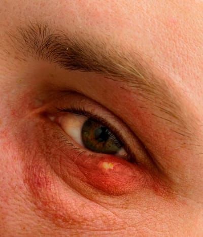 L'orgelet : causes, symptômes et traitements de cette infection oculaire courante